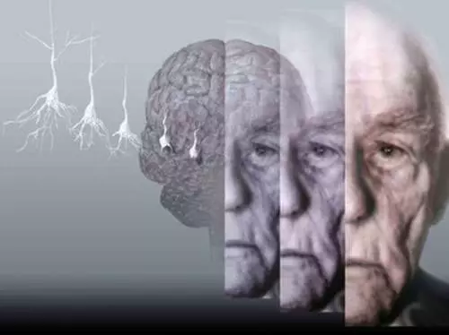 alzheimer disease