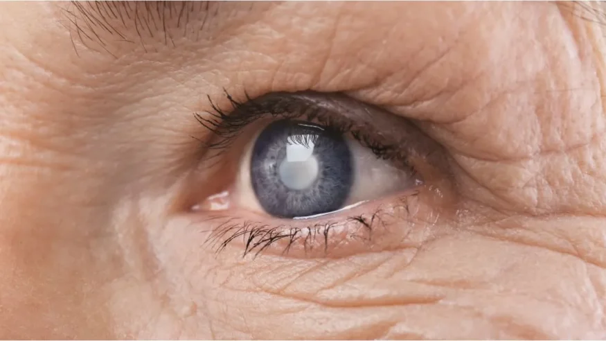 glaucoma, ph, archive