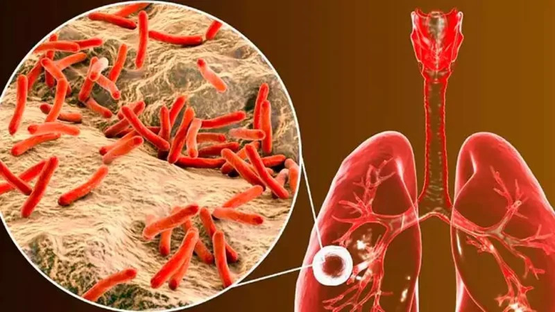 tuberculosis
