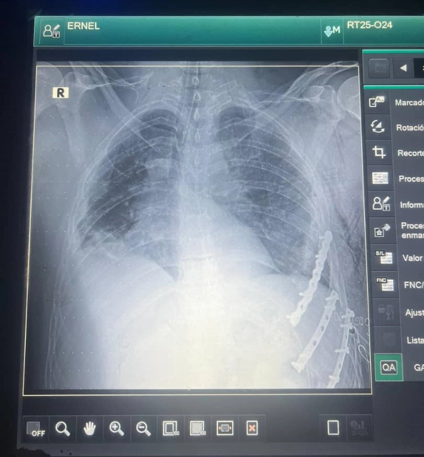 Favorable progress of Holguin patient treated for severe trauma 0
