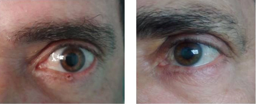 Holguin Consolidates Use of HeberFERON in Basal Cell Carcinoma 0