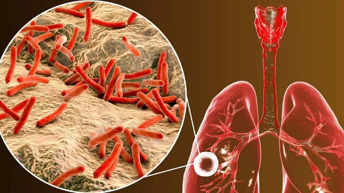 vacilo, tuberculosis