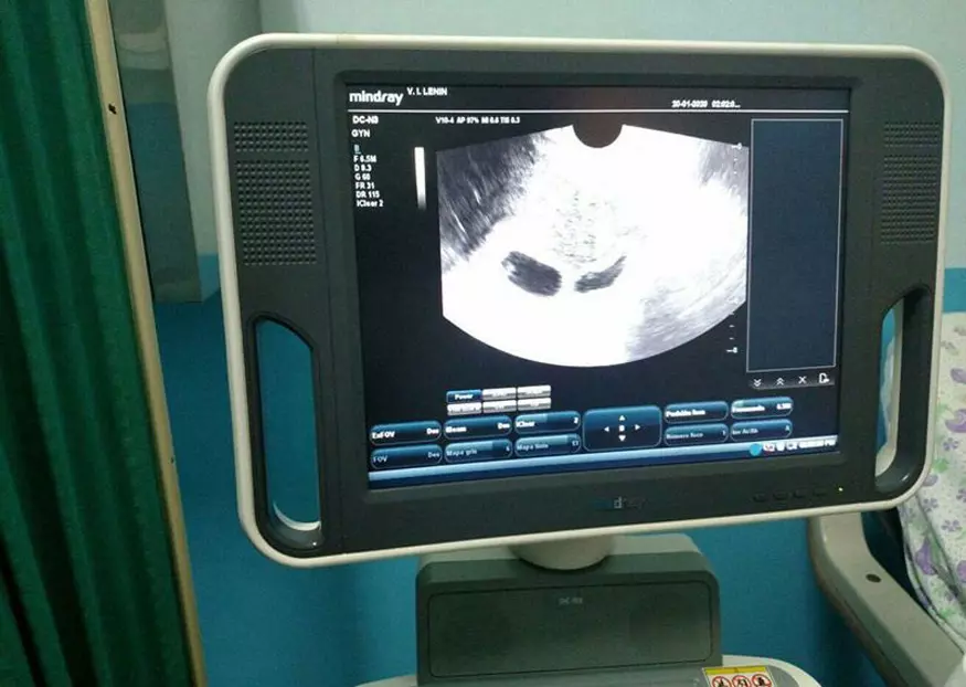 reproducciión asistida, embarazo, ultrasonido