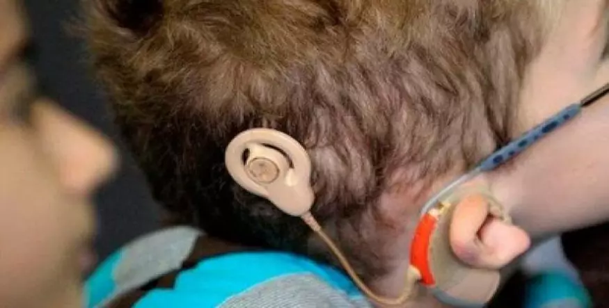 Implante coclear, Audición, Niño, Discapacidad auditiva