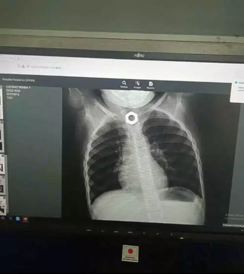 cuerpo extraño, radiografía
