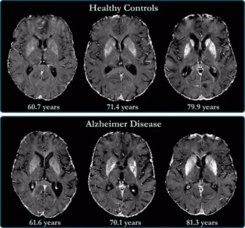 alzheimer, biomarcadores, ciencia, demencia, diagnóstico