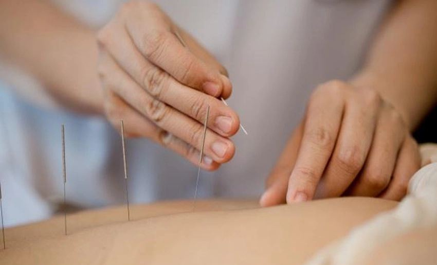 Acupuntura, técnica de Medicina Natural y Tradicional
