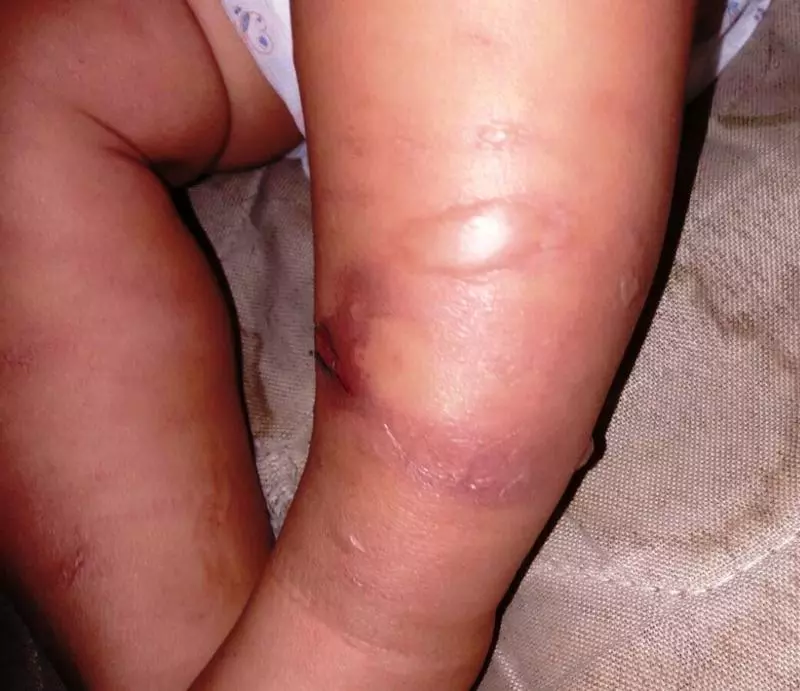 manifestaciones, manejo, Chikungunya, edades pediátricas, Holguín, salud