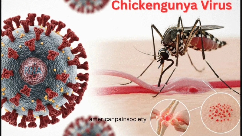 Chikungunya, complicaciones, gravedad, salud, Holguín