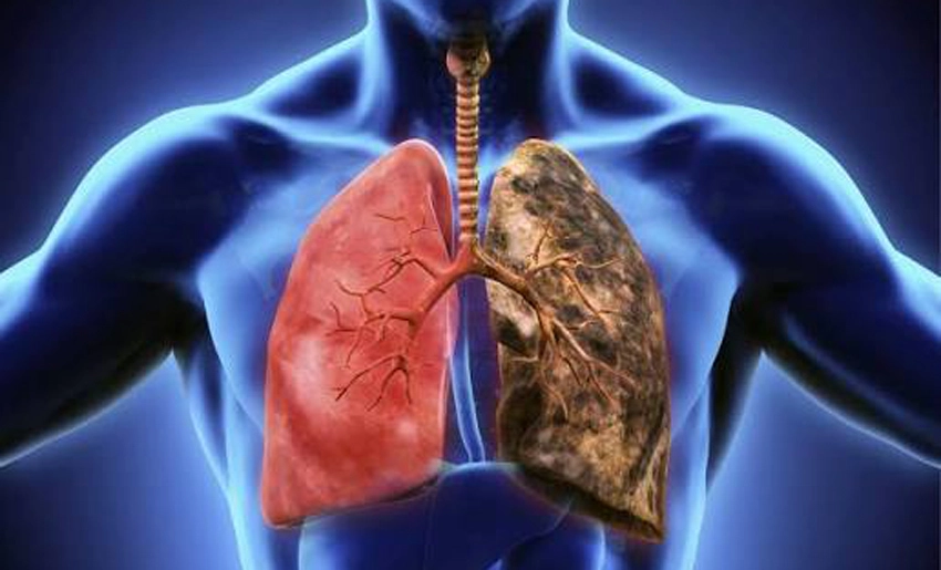 cáncer de pulmón