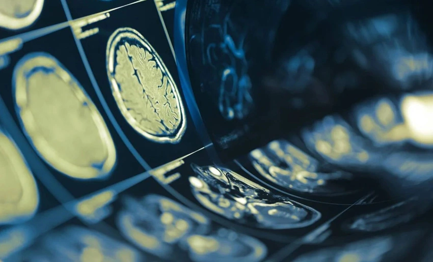tumor, cerebro, medio ambiente, salud